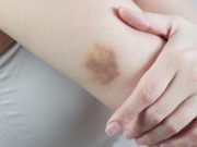 Víte, jaké jsou příznaky leukémie? Šokující zjištění nového výzkumu
